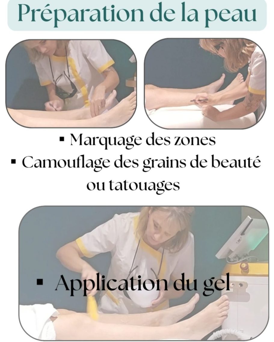 Préparation de la peau avant séance laser Préparation de la peau avec marquage, camouflage et application de gel avant épilation laser.