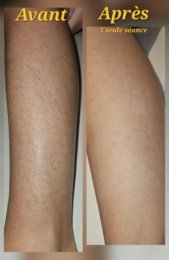 Résultat avant/après