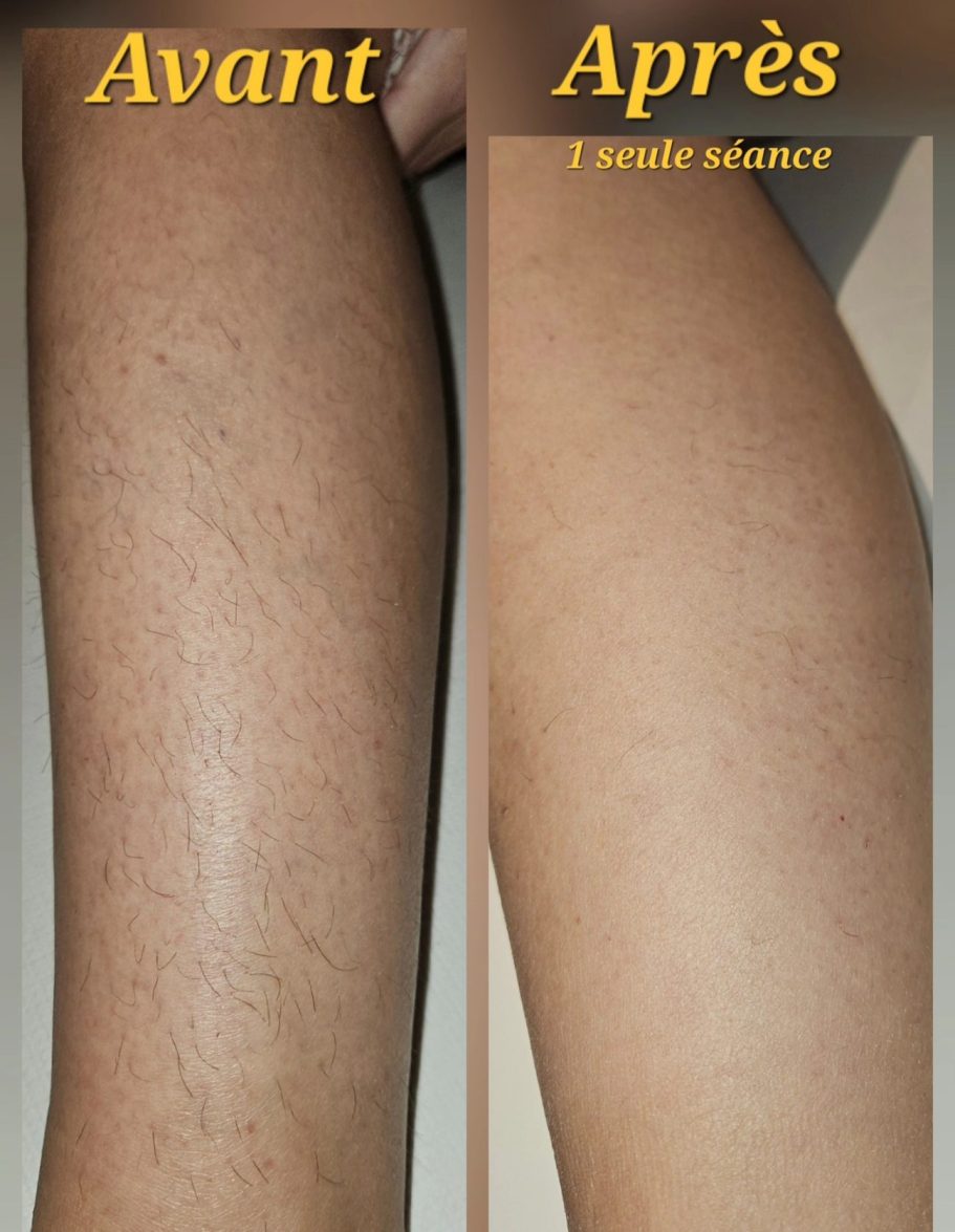 Silphéa Avant et après le traitement des jambes, montrant une peau plus lisse.