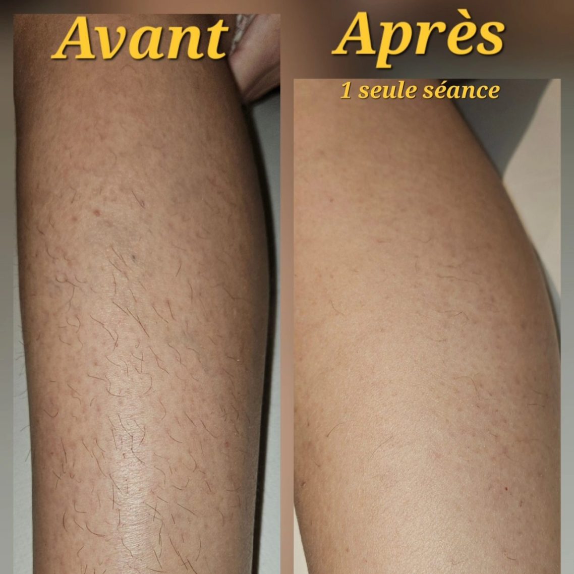 Comparaison de jambes avant et après traitement épilation laser, montrant une peau plus lisse.