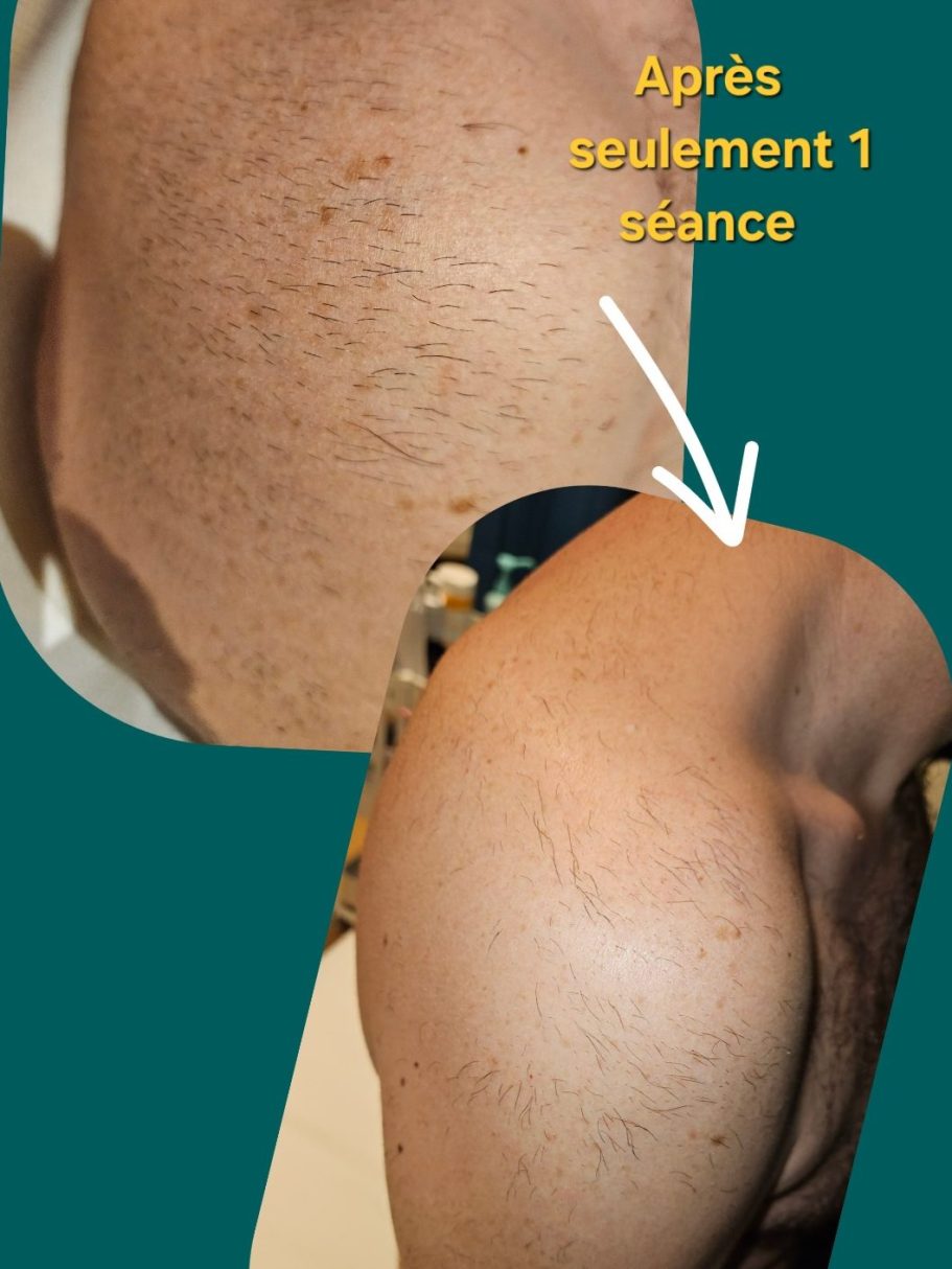 Résultats après une séance de laser Epaule montrant des poils et une amélioration visible après traitement : une séance d'épilation laser